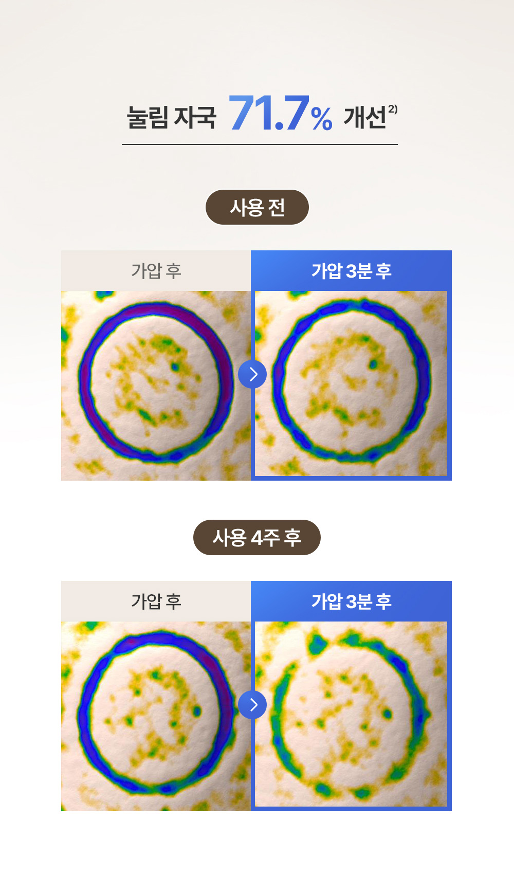 눌림 자국 71.7% 개선 사용 전 사용 4주 후 비교 사진